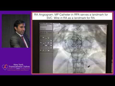 TMVR and Caval Valve Implantation - Dr.  Ravinder Rao