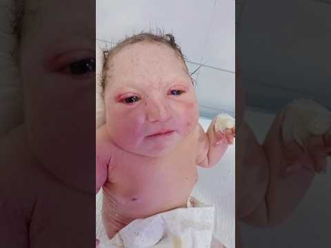 NICU Support for Microcephaly Baby | Gentle Observation#newbornbaby