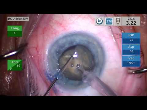 Hypermature Cataract: A Different Approach For Clearer Corneas, More Efficiency, And Safer Surgery 