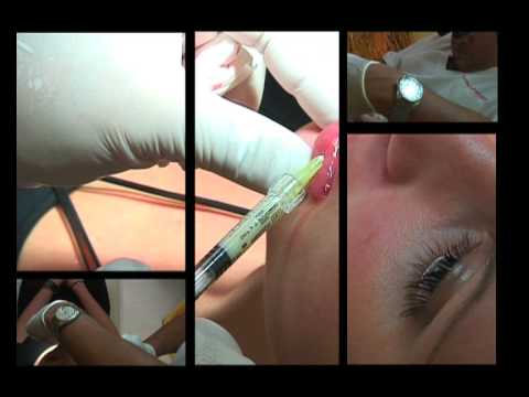 comment augmenter volume des levres