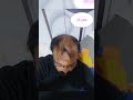 Hair Regrowth 4 Months Result Without Hair Transplant