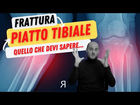 ⚠️ TIBIAL PLATEAU FRACTURE | What You Need to Know❗