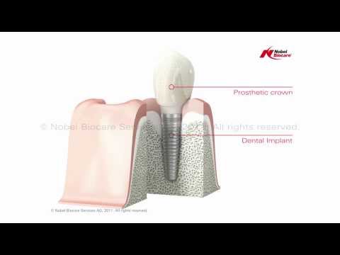 Nobel Biocare Single Dental Implant