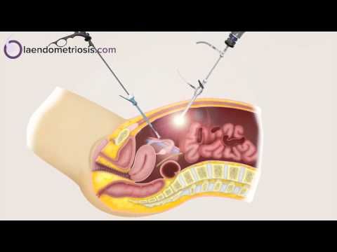 Endometriosis Localizacion Sintomas Diagnostico Y Tratamiento Endometriosis Localizacion Sintomas Diagnostico Y Tratamiento