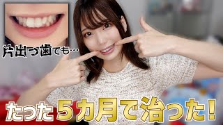 【５か月目】メリットが多い新しい矯正法！裏側矯正＆マウスピースで短期間でキレイになった！