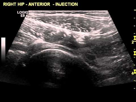 Hip joint anterior approach injection - Dr Peter Resteghini