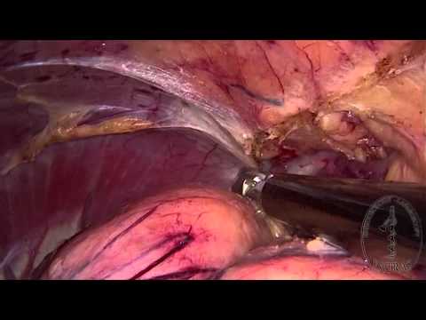 Laparoscopic Radical Nephrectomy - Upper Pole Dissection (Left)