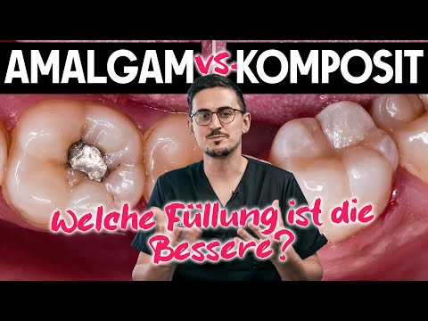 Amalgam vs Komposit - Zahnfüllungen auf dem Prüfstand