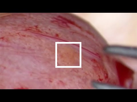 Mikrochirurgiczna ekstrakcja plemników z jąder