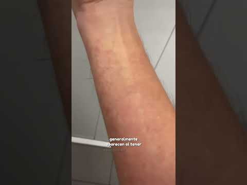 Hives🫢 #hives #medicine #doctor #urticaria #hives #allergy