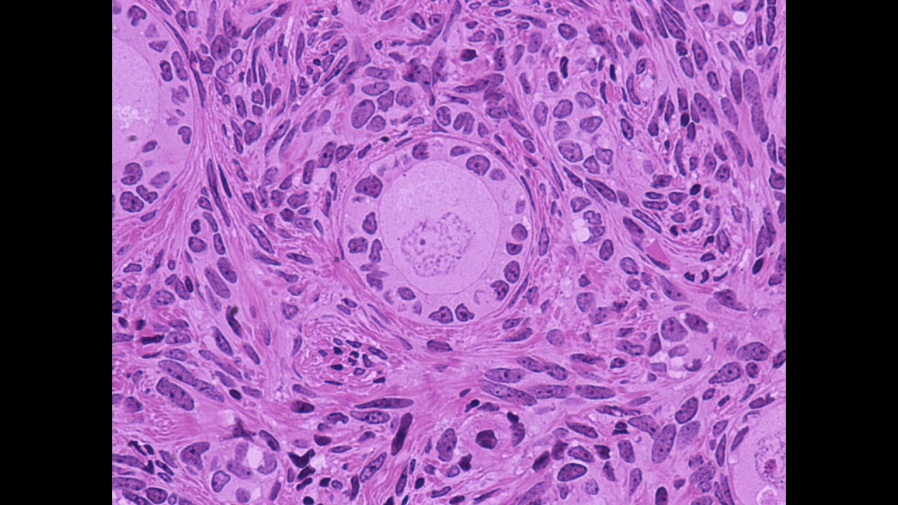 Insufficienza Ovarica Prematura 2017