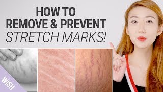 How To Get Rid of Stretch Marks Fast | Natural Remedies for Stretch Mark Removal | What