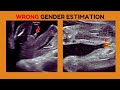Ultrasound was WRONG! Boy is a GIRL!🤔🥺 Here is Why