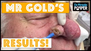 Results after Rhinophyma Treatment, Mr Gold