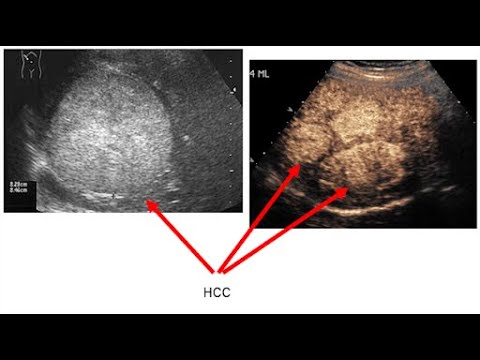 Case 161 : Liver cancer , HCC