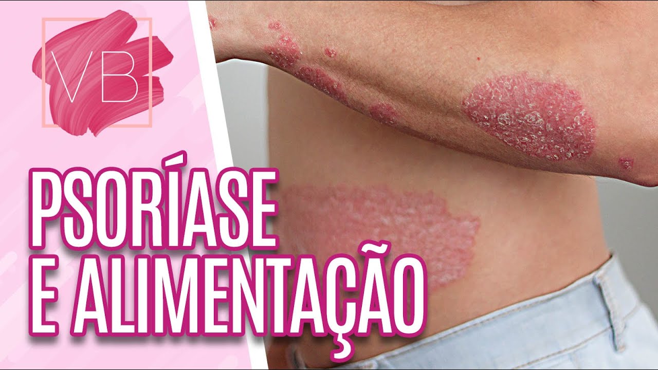 Saiba quais nutrientes podem ajudar no combate à psoríase - Você Bonita (04/02/21)