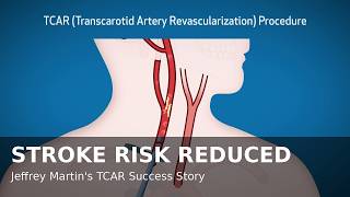 This Life-Saving Vascular Procedure Gave Jeffrey Martin a Second Chance