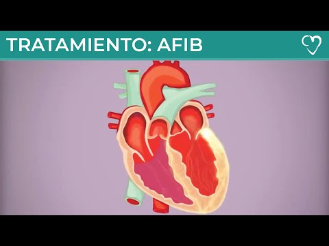Tratamiento de Aurícula Fibrilación (AFIB)