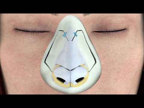 Piezotome® Rhinoplasty Protocol 3D