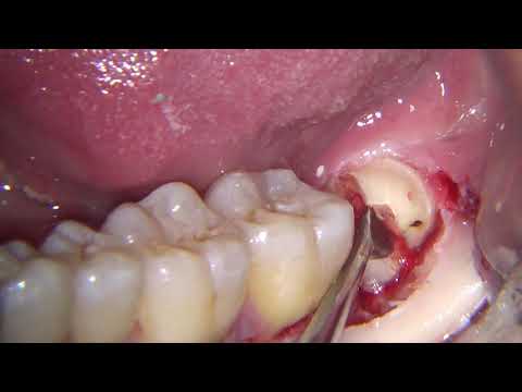 Fast lower wisdom tooth surgical extraction