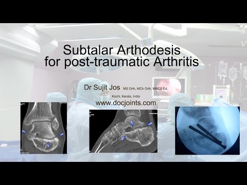 Artroza genunchiului istoric medical