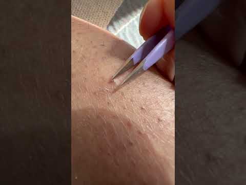 INGROWN Hairs are the Devil 😈 #sugarwax #shorts