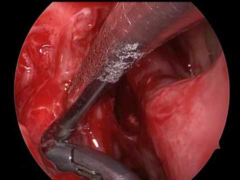 Papiloma intraductal de mama