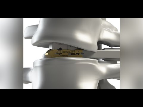 DepuySynthes: X PAC Expandable Interbody Cage and UNLEASH TLIF Procedure Animation