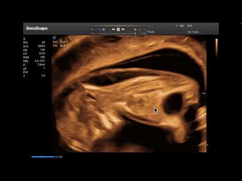 12-week pregnancy: Nuchal translucency of 7.2 mm and urinary megacystis