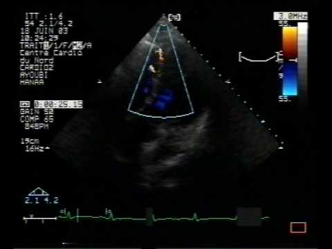 Multiple Apical Ventricular Septal Defects (2/2)