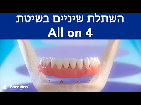 © All On 4 – השתלת שיניים בשיטת