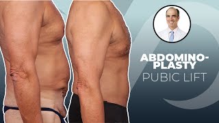 Abdominoplasty + Pubic Lift | Dr. David Stoker | Los Angeles, CA