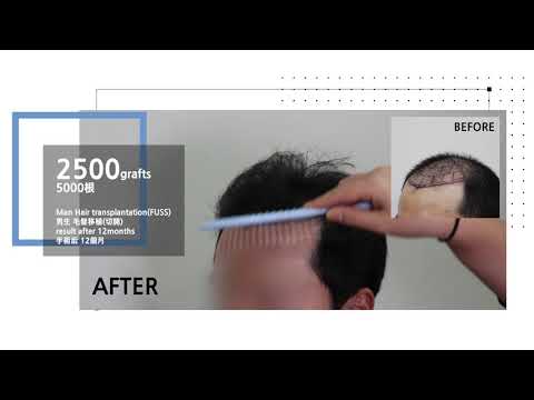 Man hair transplantation results after 12months - 뉴헤어 I 모발이식 I Before&After I