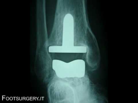 Trattamento osteocondrosi di controllo del suono Torcicollo e mascella a sinistra