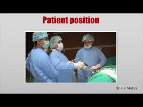 Single Incision Laparoscopic Surgery - SILS