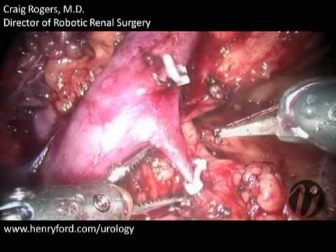 Robotic Partial Nephrectomy - Step 4: Hilar Dissection