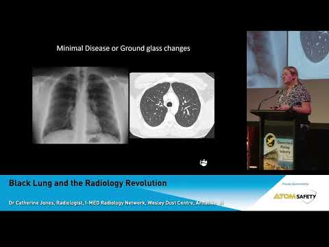 Dr Catherine Jones - Black Lung and the Radiology Revolution