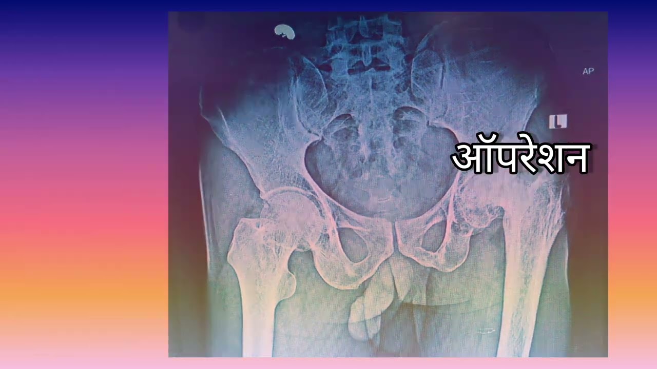 Total Hip Replacement (THR) - pt name Jalish Ahmed by Dr. Tarun solanki