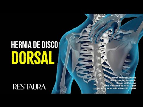 Hernia de disco dorsal o torácica