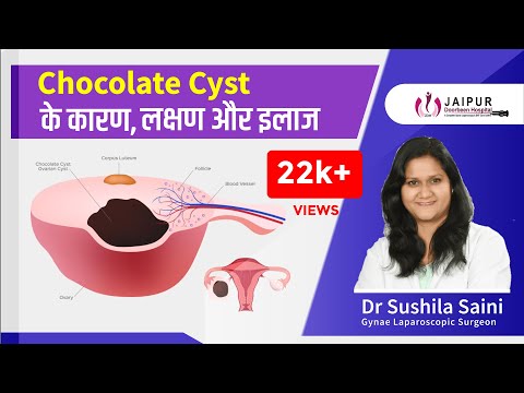 CHOCOLATE CYST के कारण, लक्षण और इलाज | Dr Sushila Saini
