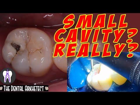 Molar Tooth Caries Removal and Restoration (Pasta sa Bagang)#42