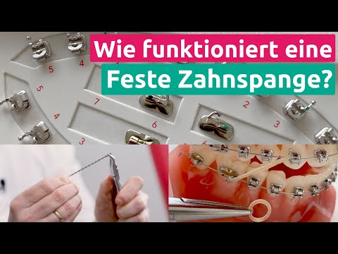 Wie genau funktioniert eigentlich eine feste Zahnspange?