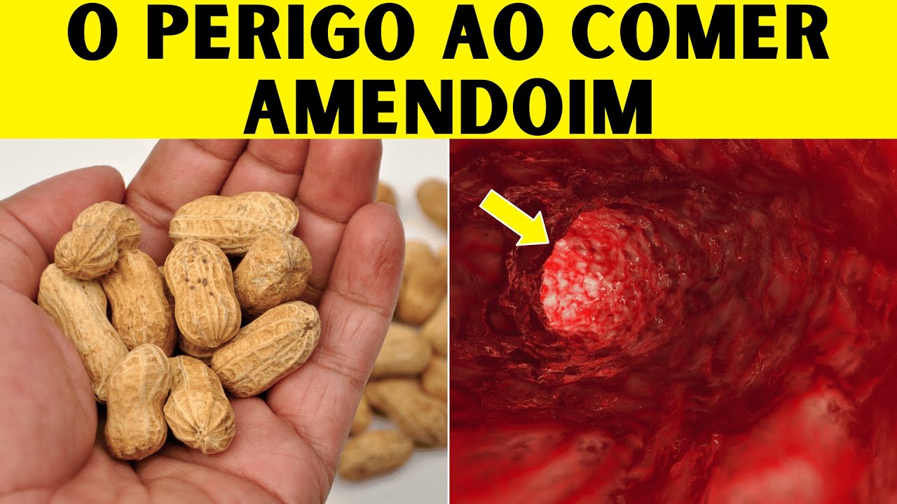 Coma Amendoim, mas Evite Erro que Pode ser Fatal