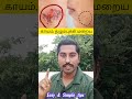தழும்புகள் எளிதில் மறைய simple Tips Thalumbu Maraiya Ti