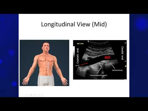 Using POCUS to screen for Abdominal Aortic Aneurysm AAA