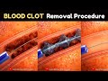 Blood Clot Removal Procedure Medical Animation