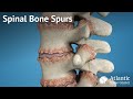 Spinal Bone Spurs