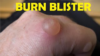 how to treat a burn blister on finger