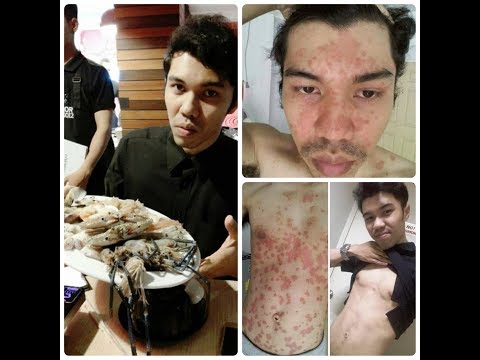 โรคสะเก็ดเงินในปี olds ความคิดเห็น beloderm กลาก