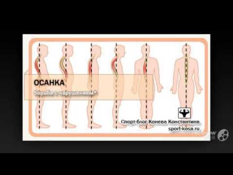 Гимнастика для сколиоза 1 степени Сколиоз фото детей 2 степени